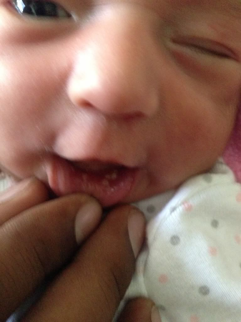 White Spots In Mouth Child