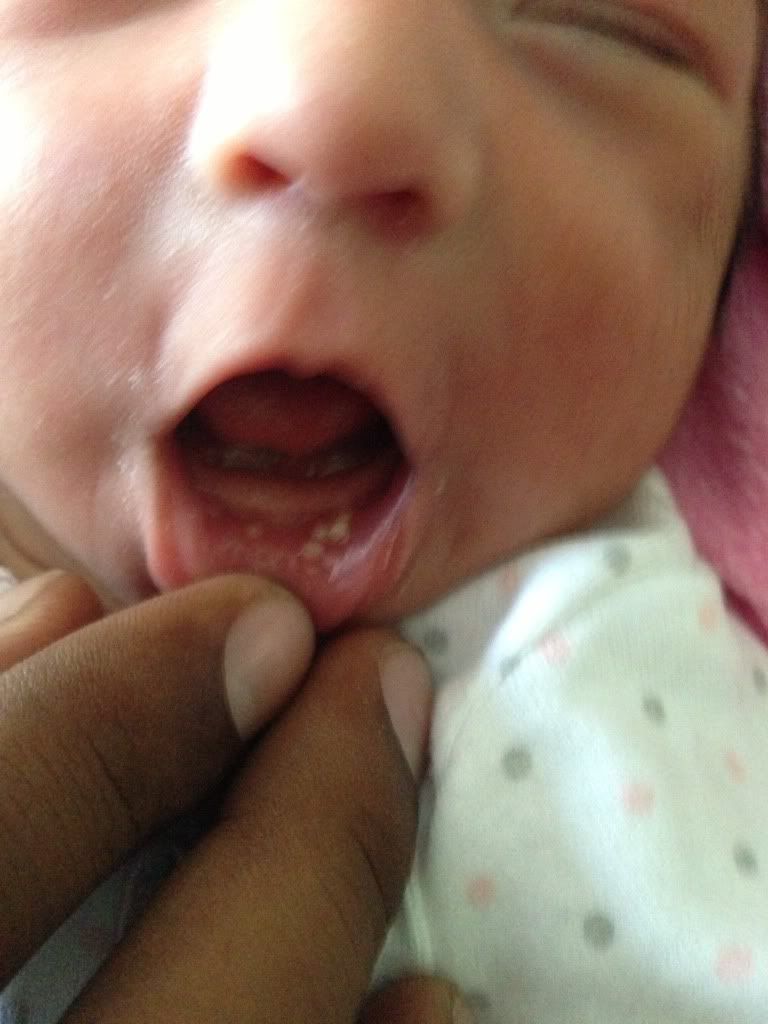 Baby Has White Spots In Mouth